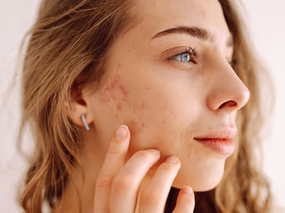 091825-problem-areas-acne