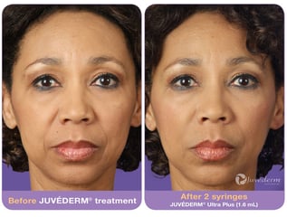 juvederm4