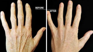 radiesse-hands-fort-lauderdale