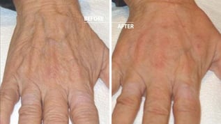 radiesse-hands-weston