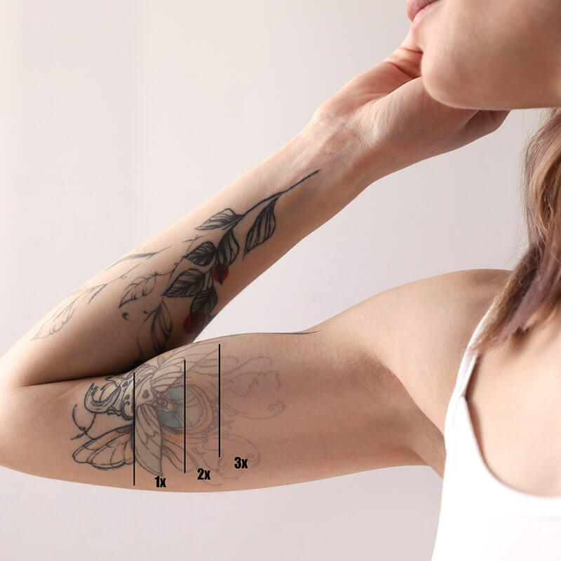 092525-services-tattoo-removal-process