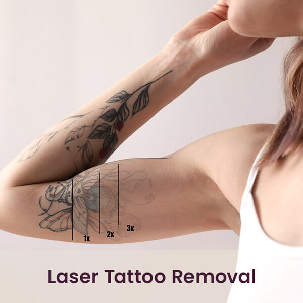 100625-before-after-tattoo-removal
