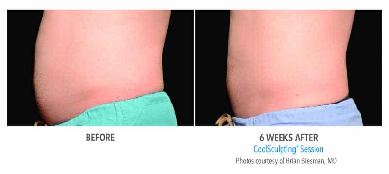 Coolsculping-abdomen5