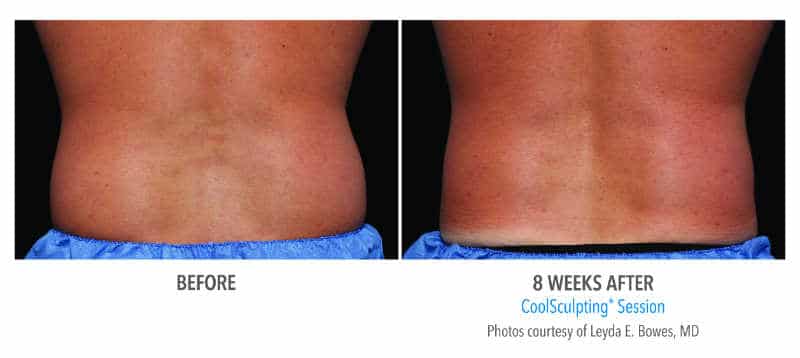 Coolsculping-flank2