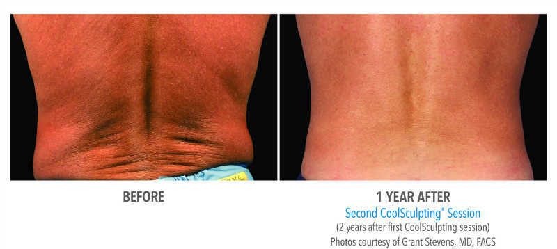 Coolsculping-flank3
