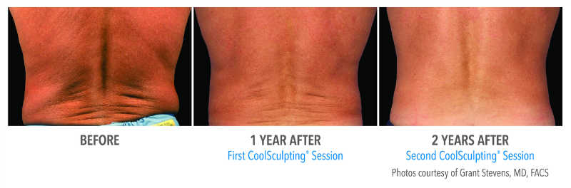 Coolsculping-flank4