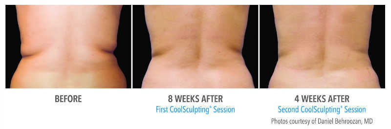 Coolsculping-lovehandles