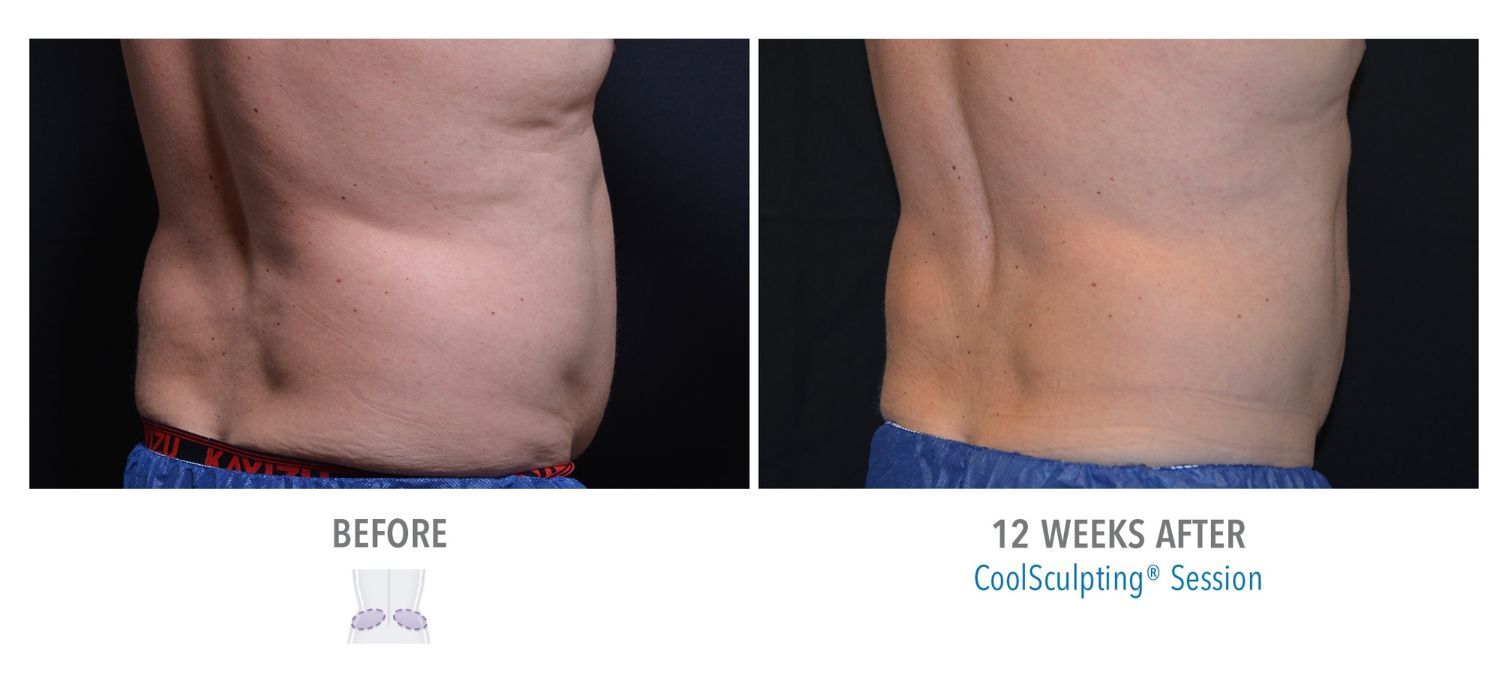 coolsculpting-weston-male-lower-abs01-1