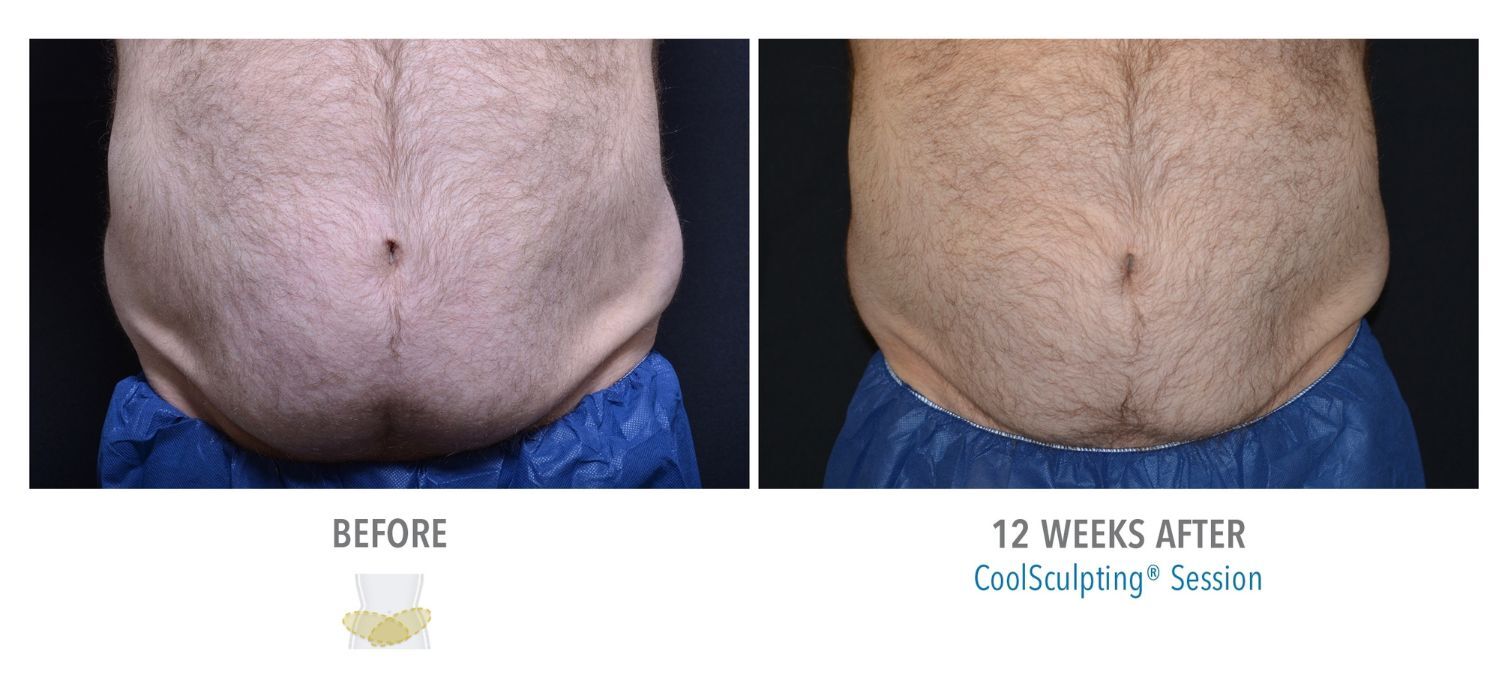 coolsculpting-weston-male-lower-abs01