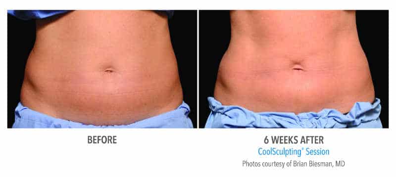 Coolsculping-Beisman8