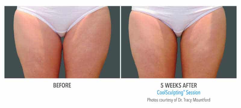 Coolsculping-thighs2