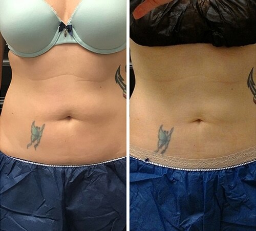 coolSculpting-weston-02