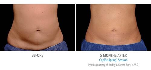 coolsculpting-before-after-2021-01