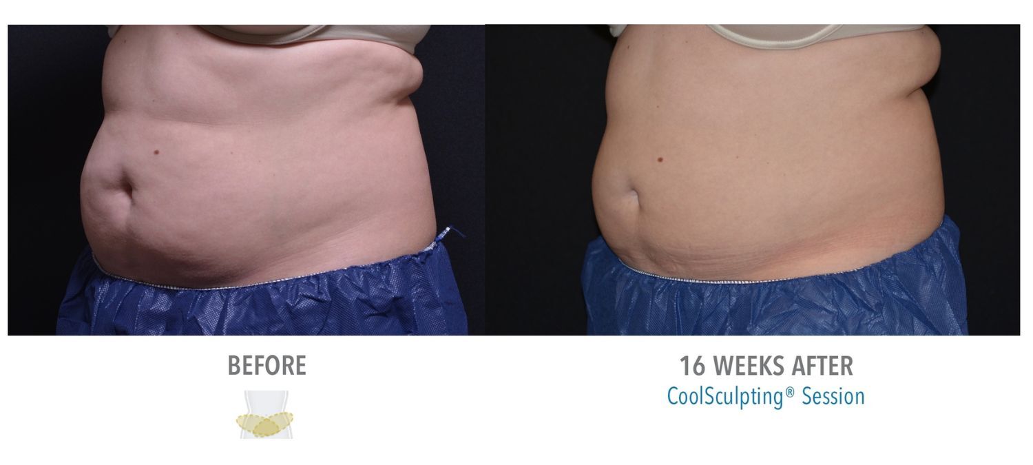 coolsculpting-weston-female-lower-abs01-1