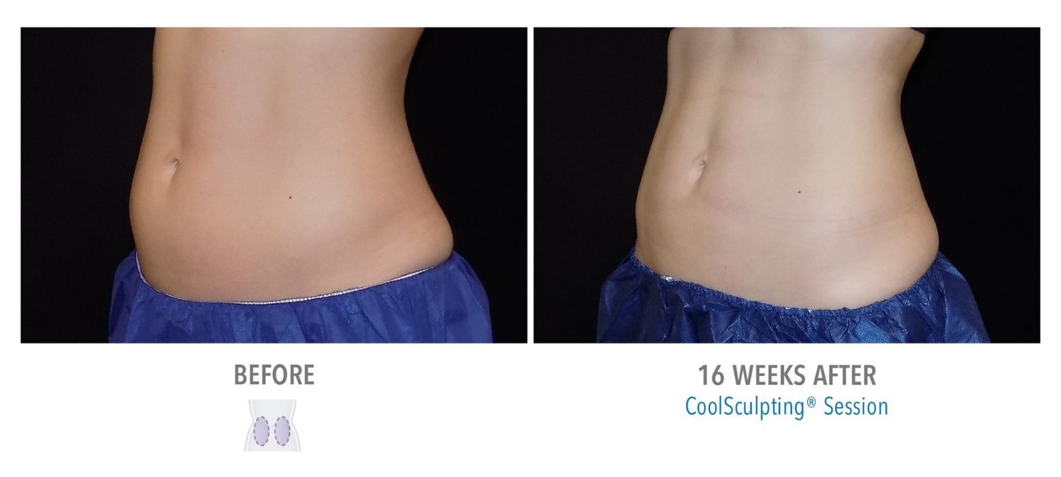 coolsculpting-weston-female-lower-abs01