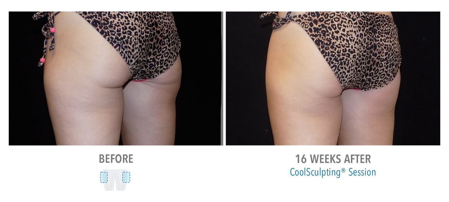 coolsculpting-weston-outer-thighs-16weeks01