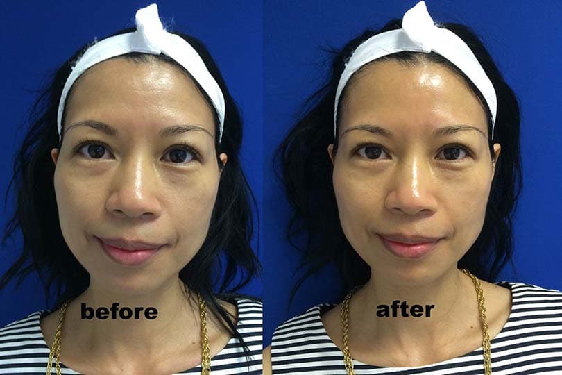HydrafacialagelessBefore-After-HydraFacial-3