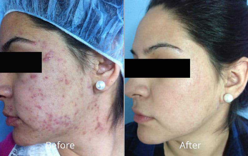 hydrafacial-before-afterManuf