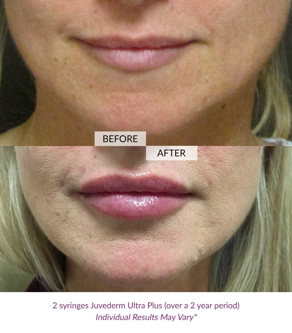 fillers-lips-ageless-01