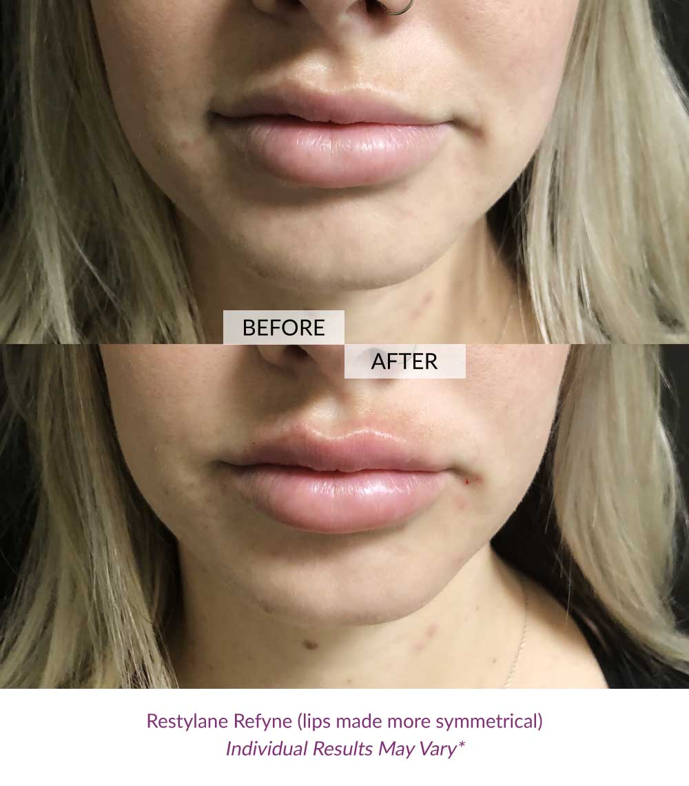 fillers-lips-ageless-02