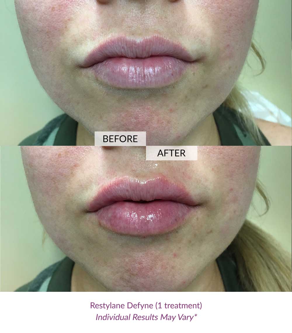 fillers-lips-ageless-03