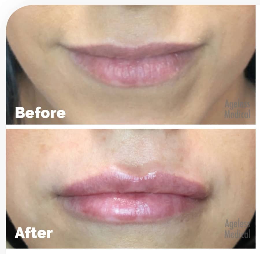 lip-fillers-fort-lauderdale01