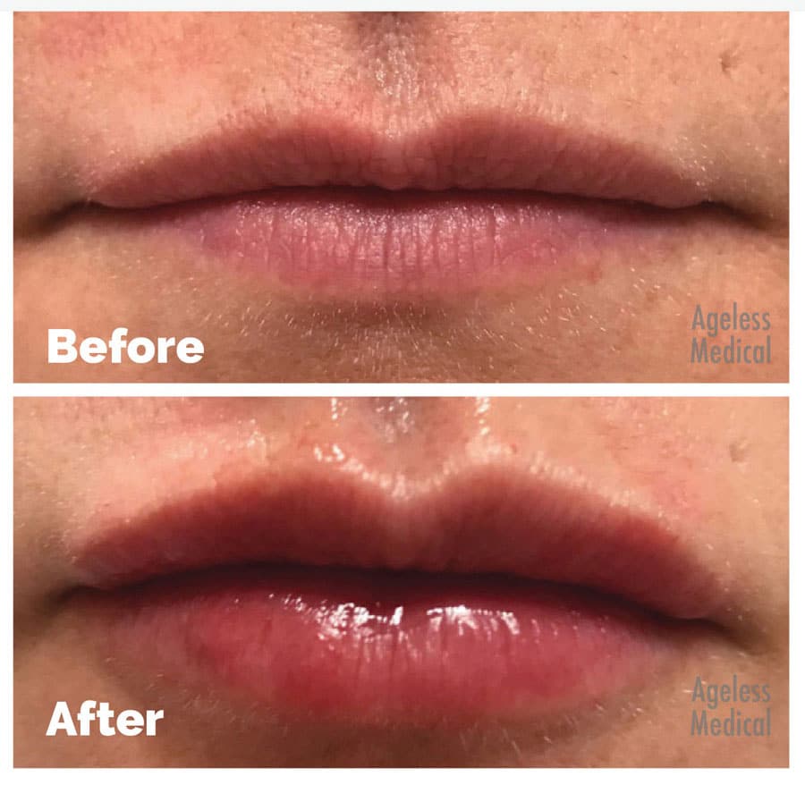lip-fillers-fort-lauderdale02