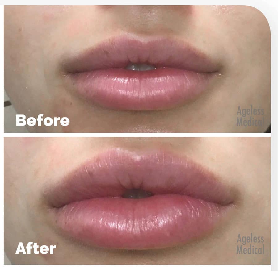 lip-fillers-fort-lauderdale03