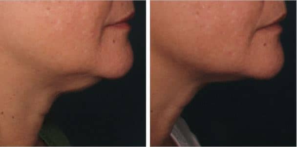 ageless-ultherapy-weston-01