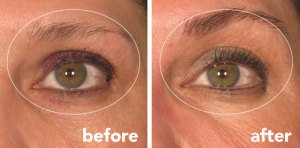 ultherapy-eyes-300x148-1