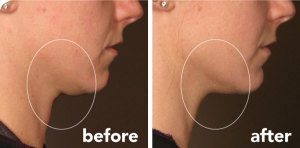 ultherapy-lower-face-300x148-1