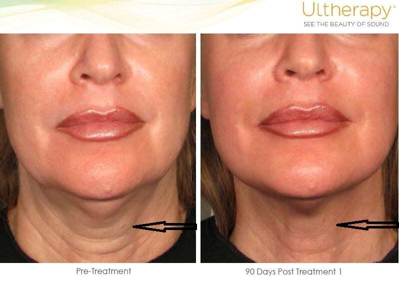 ultherapy-manuf2