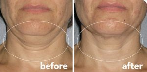 ultherapy-neck-300x148-1