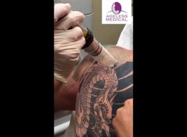Laser Tattoo Removal 2