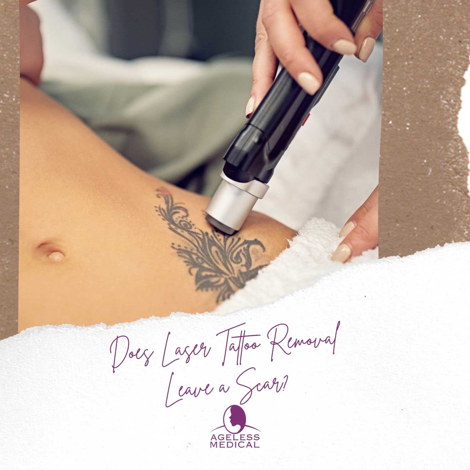 Does Laser Tattoo Removal Leave a Scar? | Ageless Medical