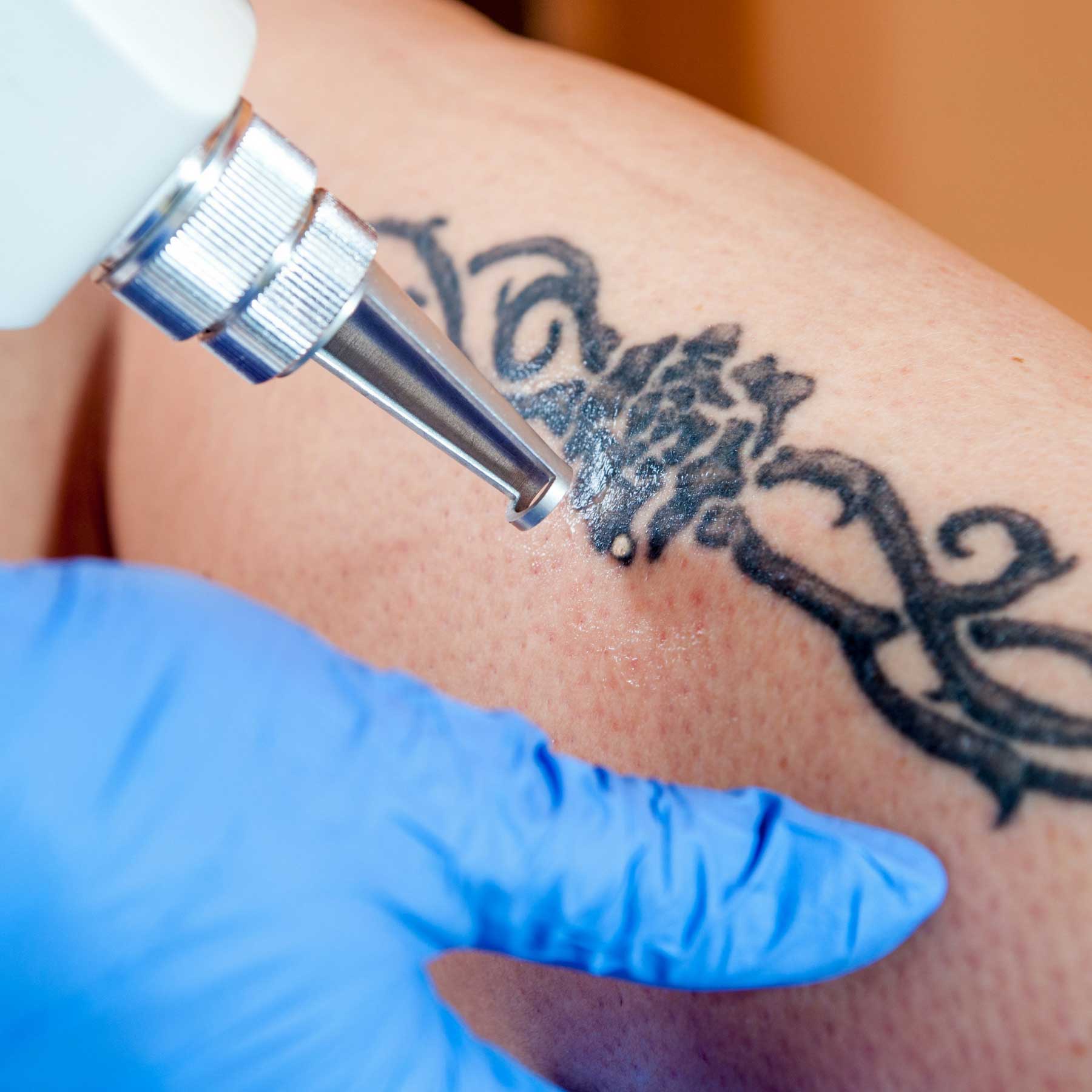 rapid tattoo removal south florida