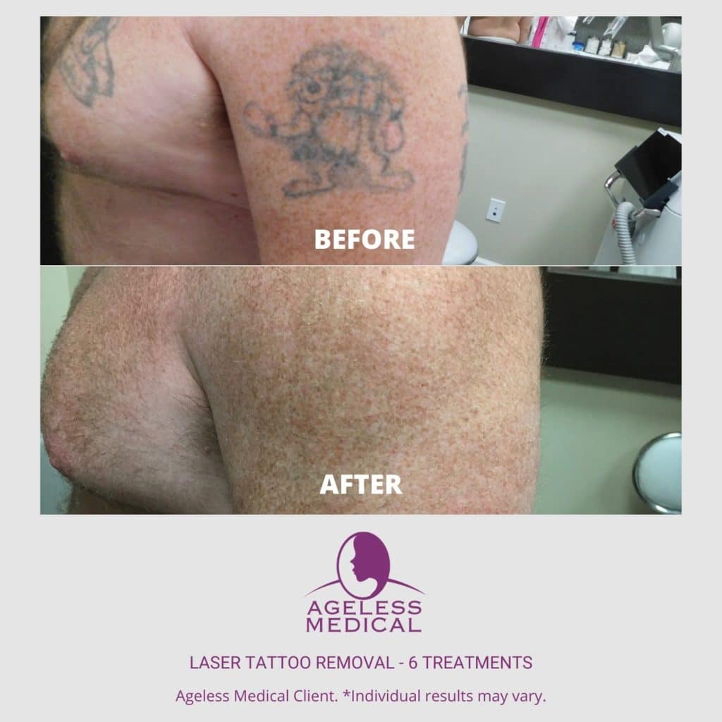 Laser Tattoo Removal | Ageless Medical | Premier Medspa serving Weston,  Pembroke Pines and Davie