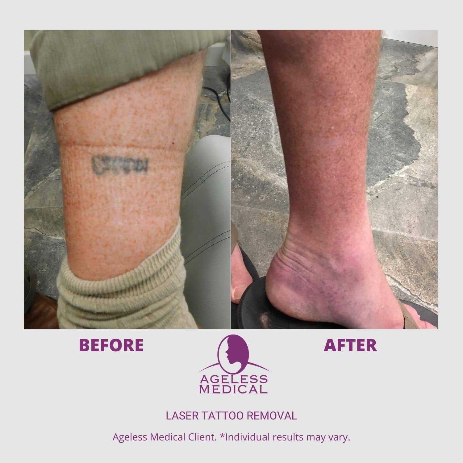 laser tatoo removal treatment at our dermatologists office in Kansas City  treating laser tatoo removal