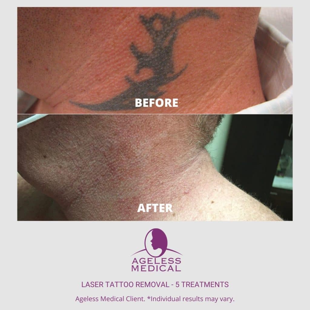 tattoo removal scar