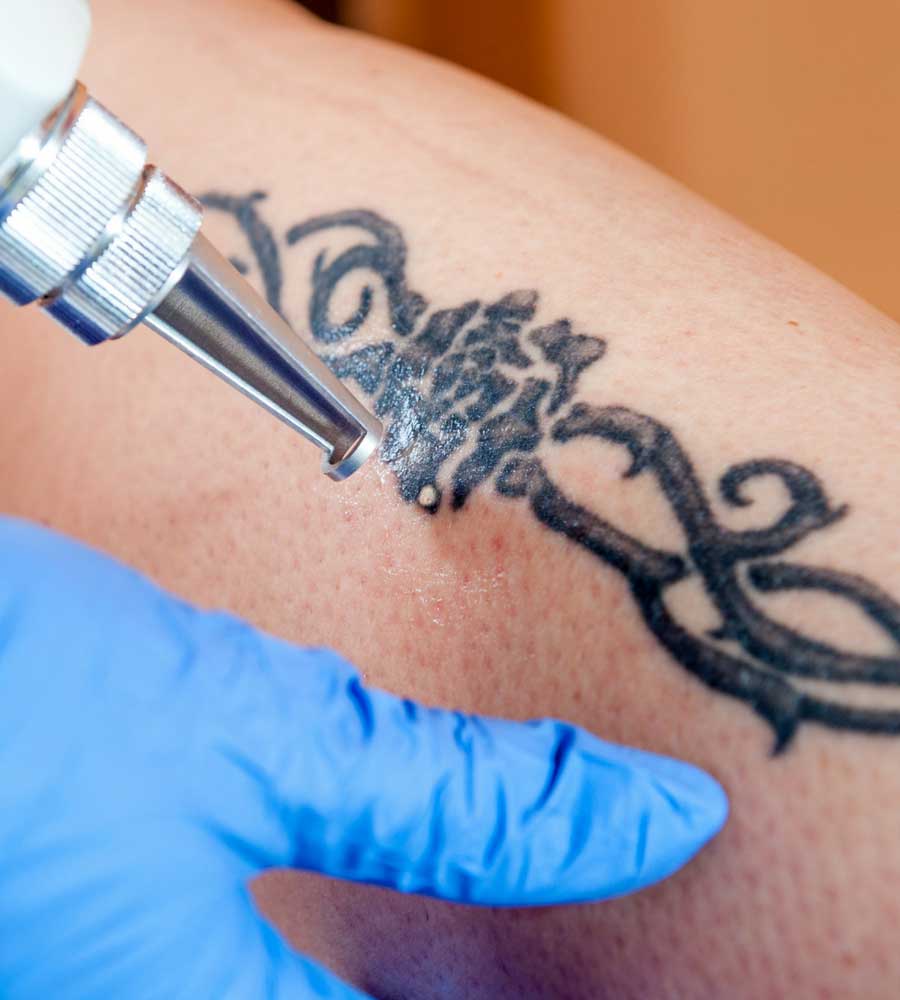 best laser tattoo removal for men in weston
