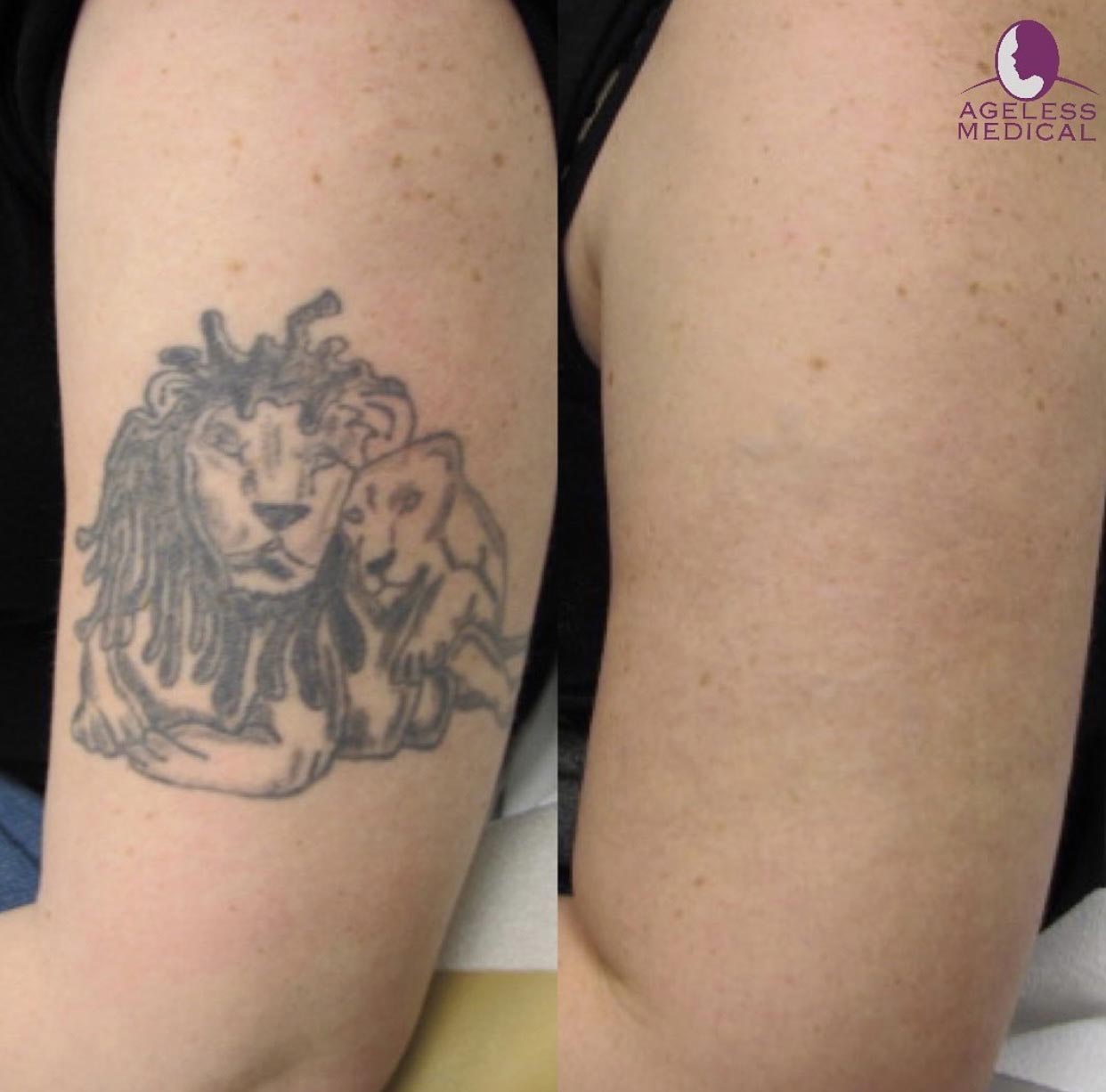 tattoo removal south florida