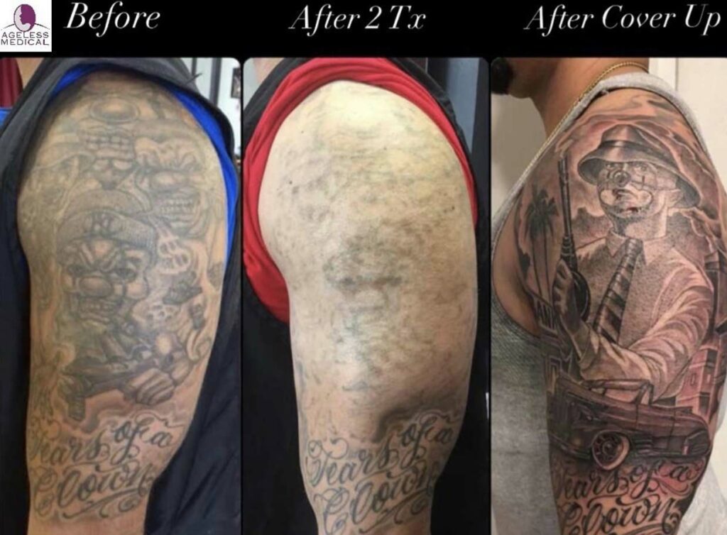 tattoo removal and coverup south florida