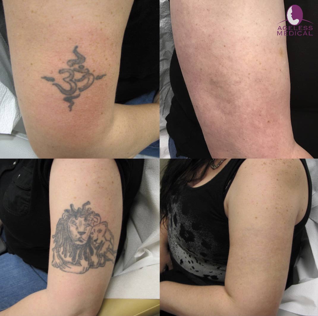 tattoo removal south florida