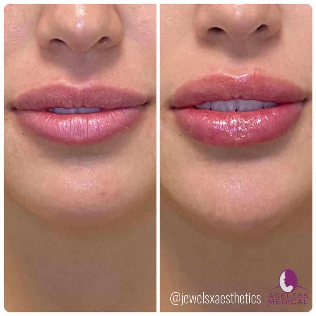 lip fillers florida before and after-2